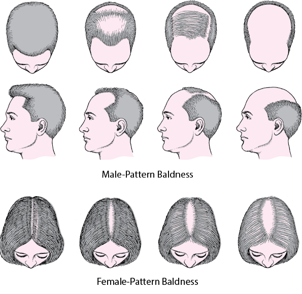 تساقط الشعر عند الرجال والنساء