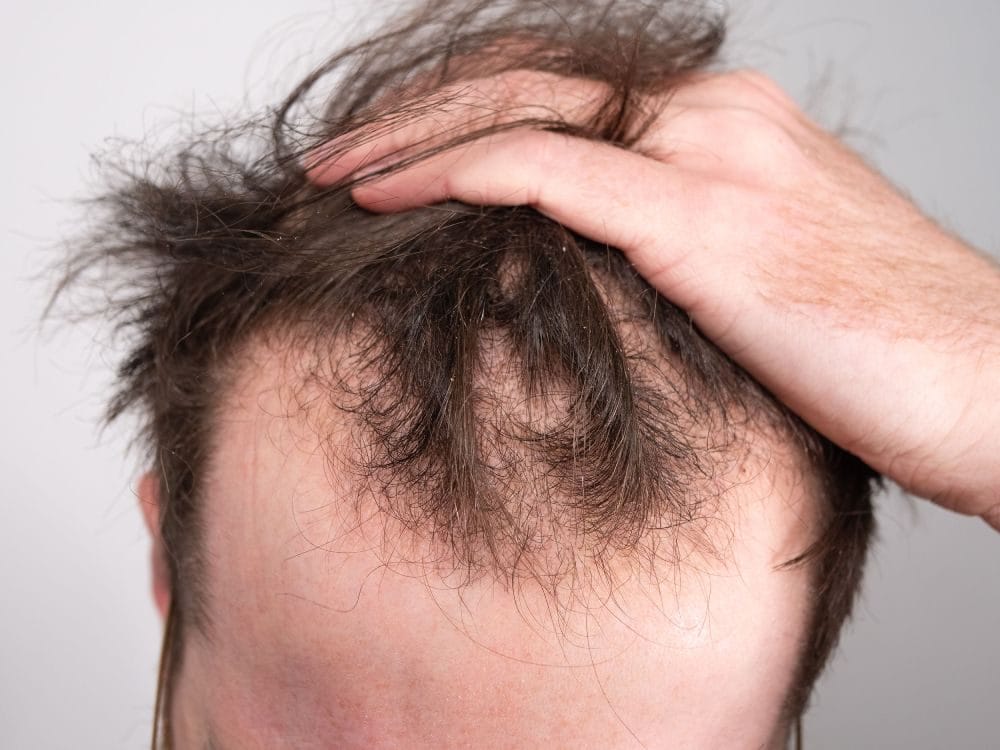 رجل يعاني من تساقط الشعر